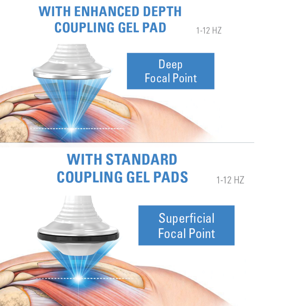 Focused shockwave therapy depth comparison using enhanced and standard coupling gel pads
