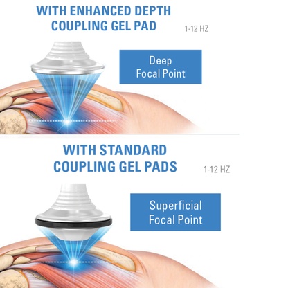 Focused shockwave therapy depth comparison using enhanced and standard coupling gel pads